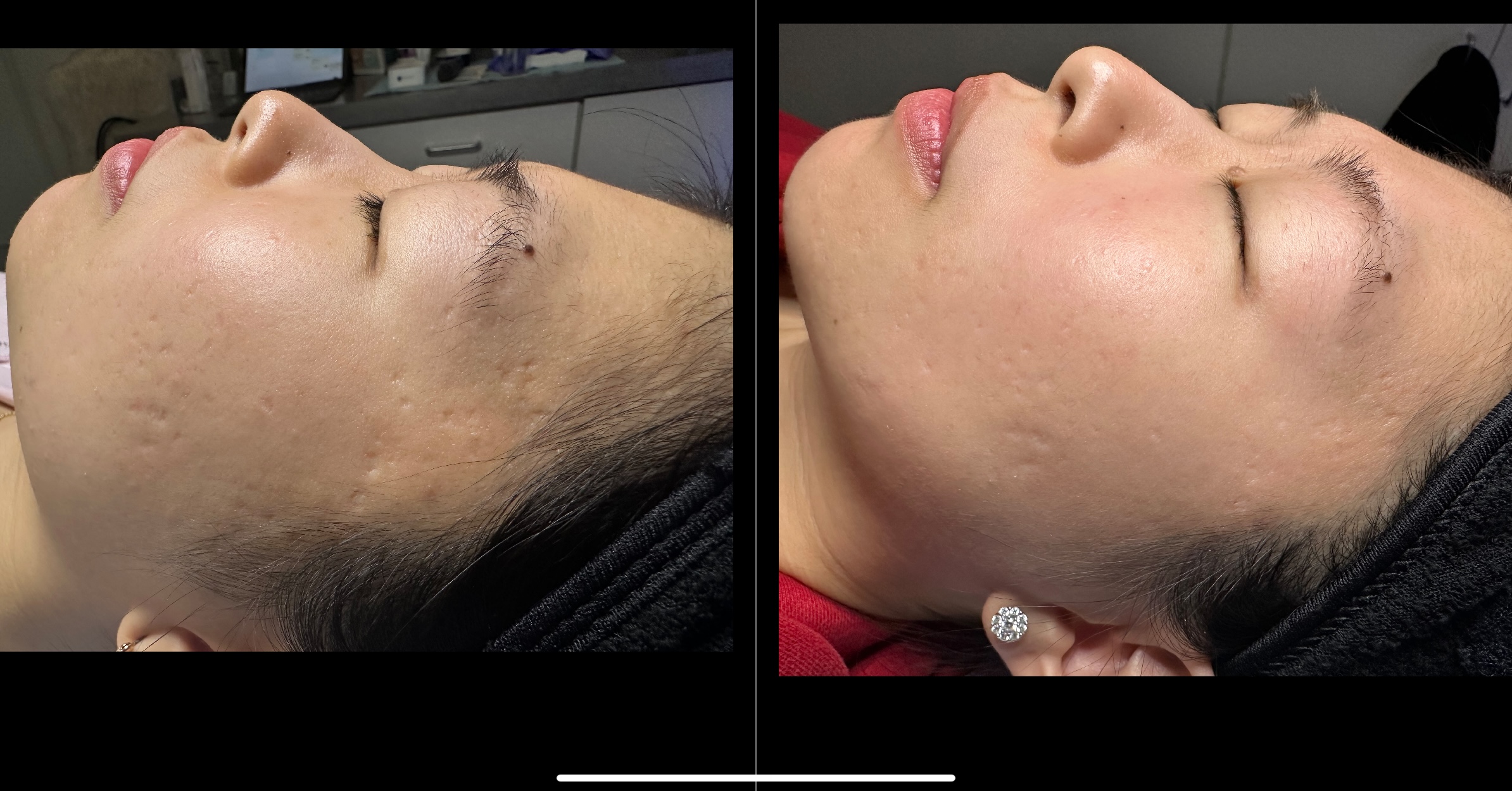 Microneedling 1 Marge Image