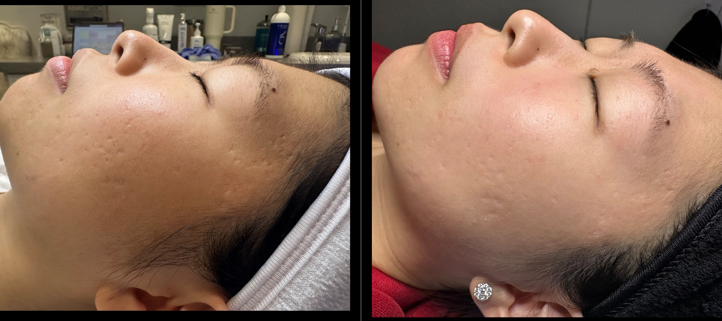 Microneedling 1 Marge Image